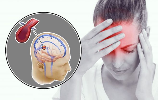 Рецепт очищения сосудов головного мозга, которым пользуются сами врачи! Забудьте о головной боли!